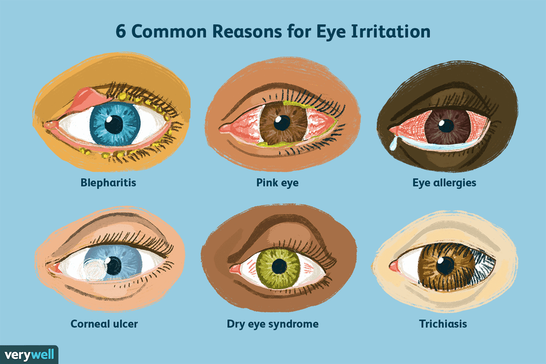 Oasis for Your Eyes: Eye Allergy Relief in Dubai